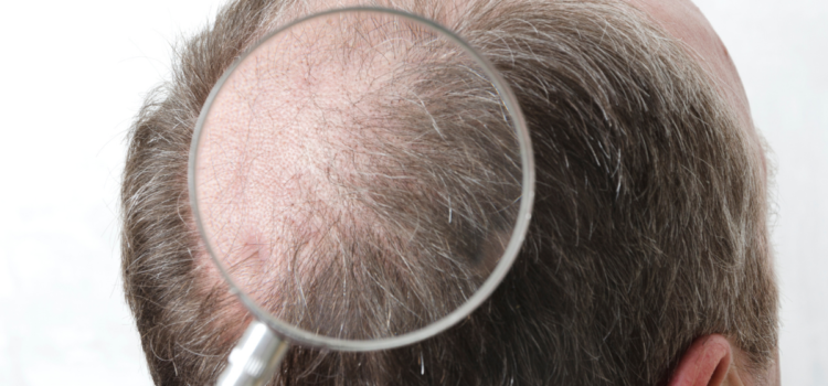 Przeszczep włosów – kuracja PRP