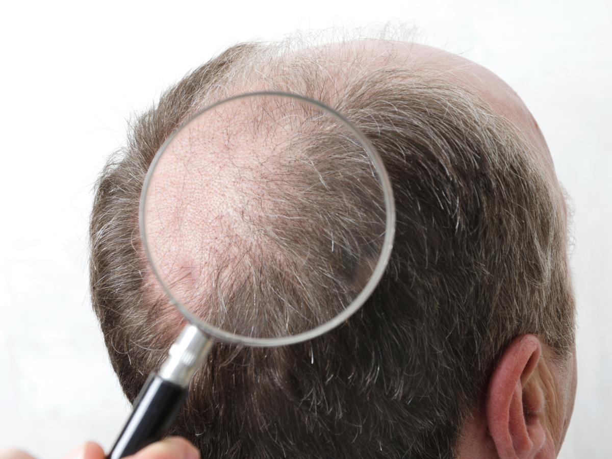 Przeszczep włosów - kuracja PRP